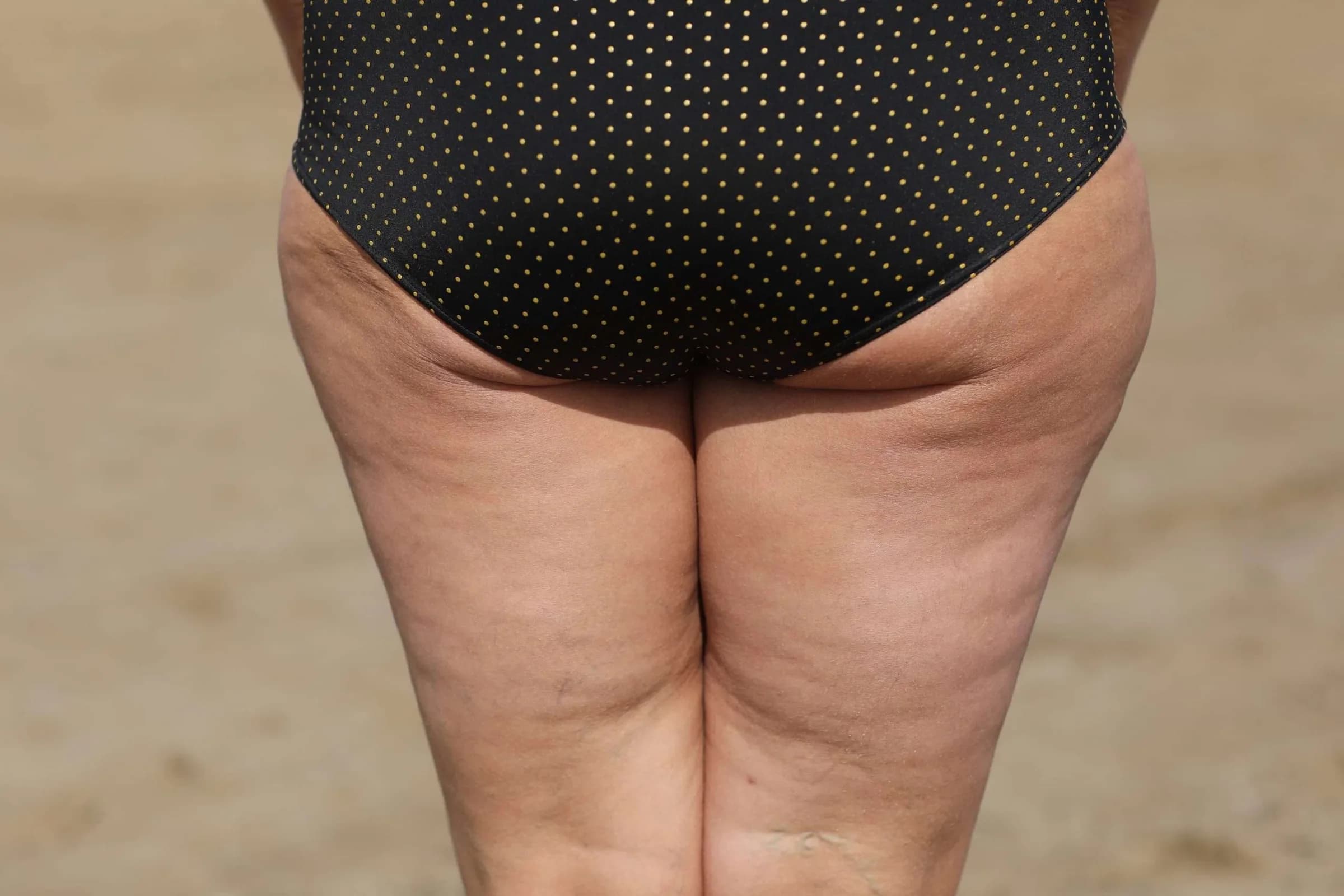 Cellulite or lipedema