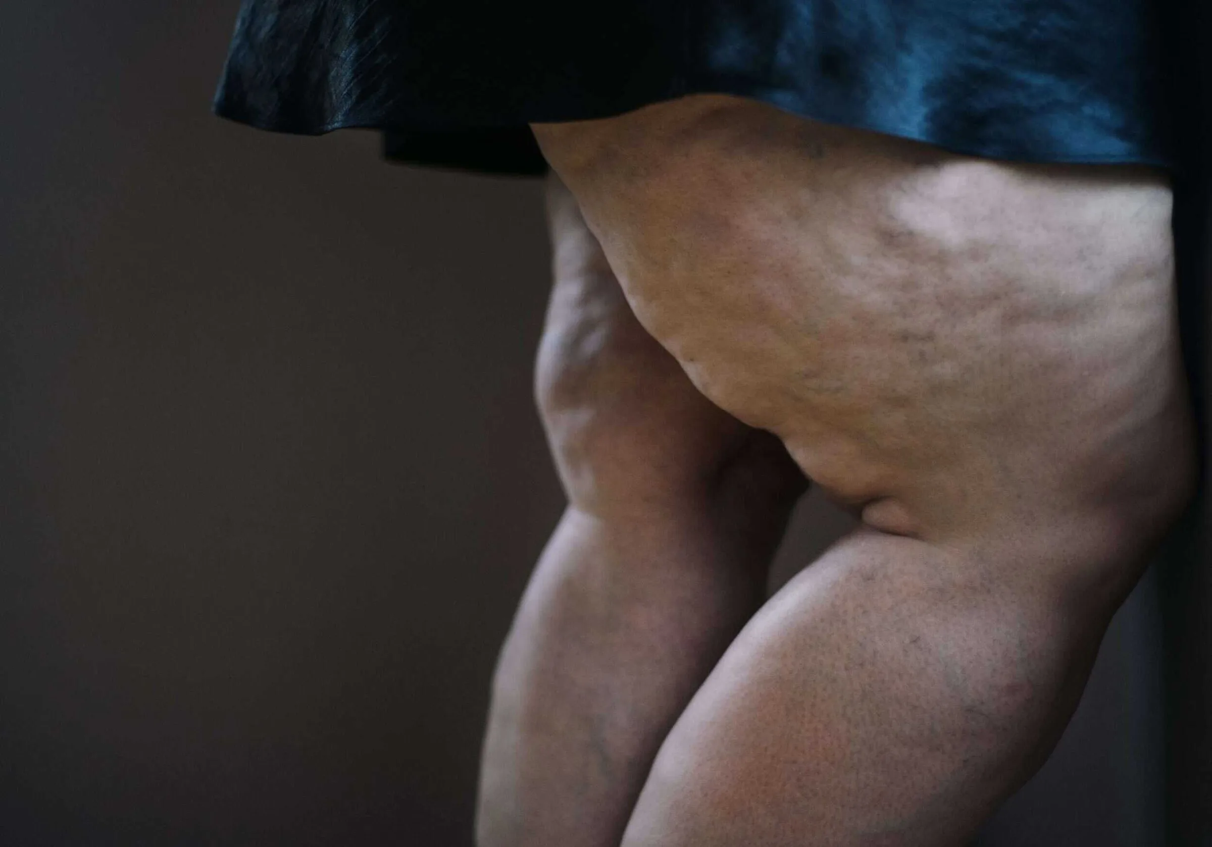 Lipedema legs